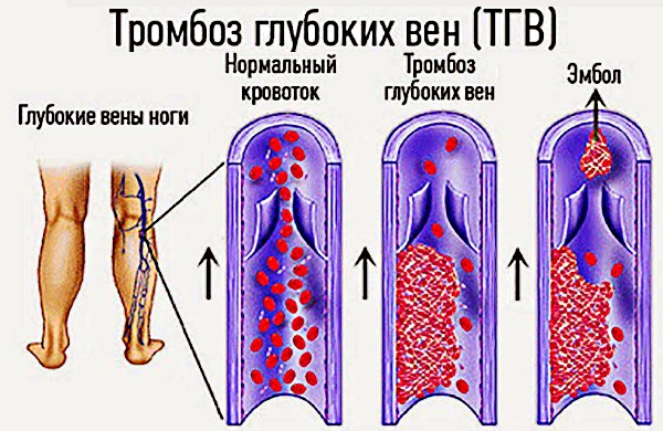 Жидкость в колене симптомы фото