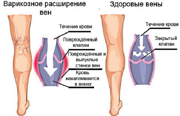 Болят ноги от колена до ступни. Причины и лечение народными средствами, медикаменты. К какому врачу обратиться