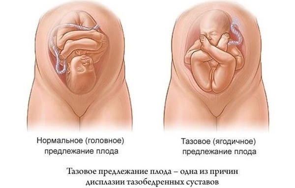 Дисплазия тазобедренных суставов у новорожденного. Симптомы, признаки, лечение