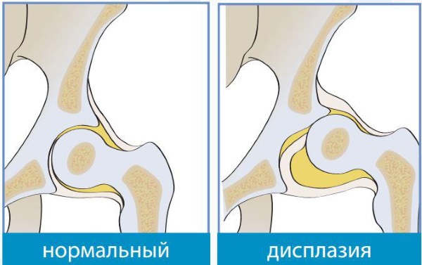 Дисплазия тазобедренных суставов у новорожденного. Симптомы, признаки, лечение