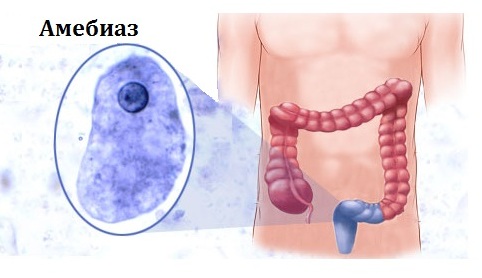 Дизентерия. Симптомы и лечение у взрослых народными средствами, лекарствами. Как передается возбудитель