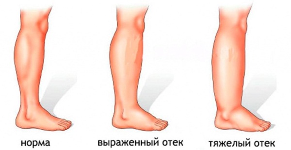 Дюфастон. Побочные действия, эффект при беременности, планировании, задержке месячных