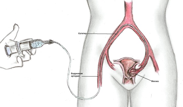 Эмболизация маточных артерий при миоме матки. Что это такое, осложнения, противопоказания. Цена и отзывы пациентов