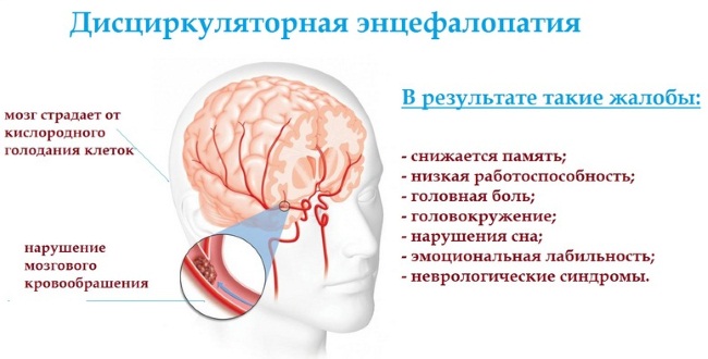 Энцефалопатия головного мозга. Что это такое, симптомы, лечение после инсульта, травмы, наркоза, операции народными средствами, лекарствами