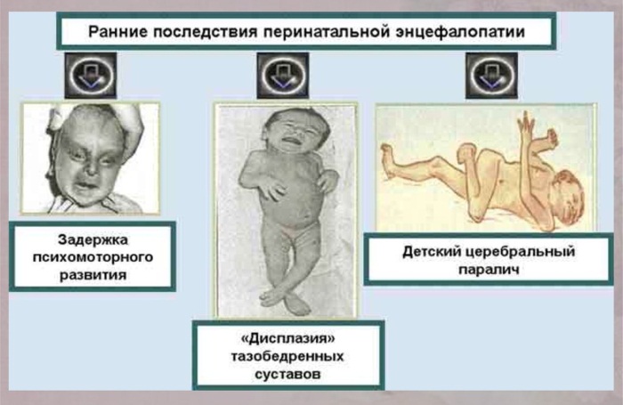 Энцефалопатия головного мозга. Что это такое, симптомы, лечение после инсульта, травмы, наркоза, операции народными средствами, лекарствами