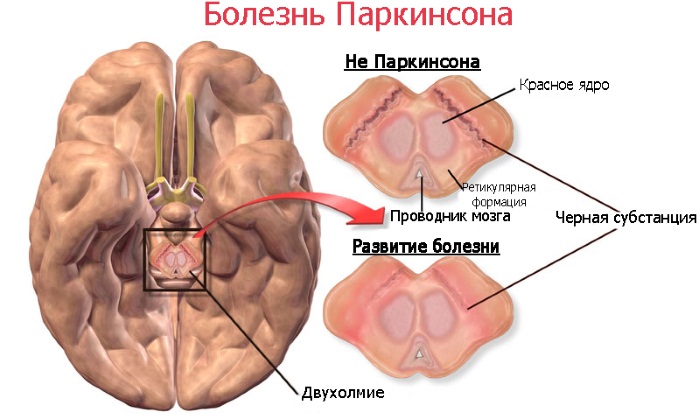 Энцефалопатия головного мозга. Что это такое, симптомы, лечение после инсульта, травмы, наркоза, операции народными средствами, лекарствами