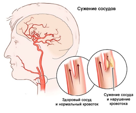 Энцефалопатия смешанного генеза судорожный синдром