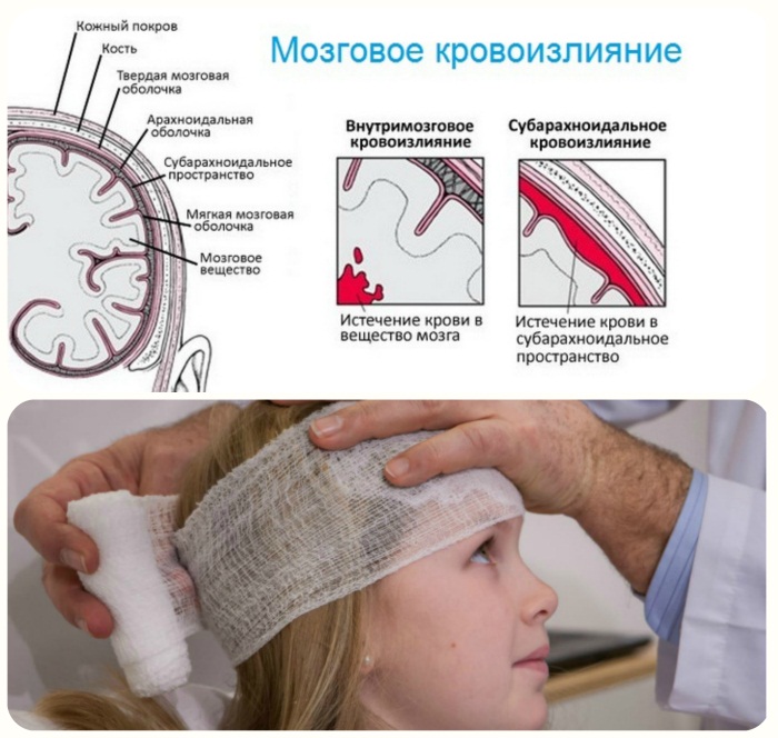 Энцефалопатия головного мозга. Что это такое, симптомы, лечение после инсульта, травмы, наркоза, операции народными средствами, лекарствами