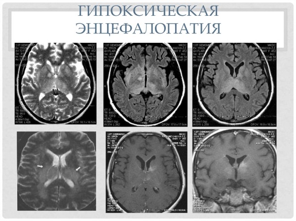 Энцефалопатия головного мозга. Что это такое, симптомы, лечение после инсульта, травмы, наркоза, операции народными средствами, лекарствами