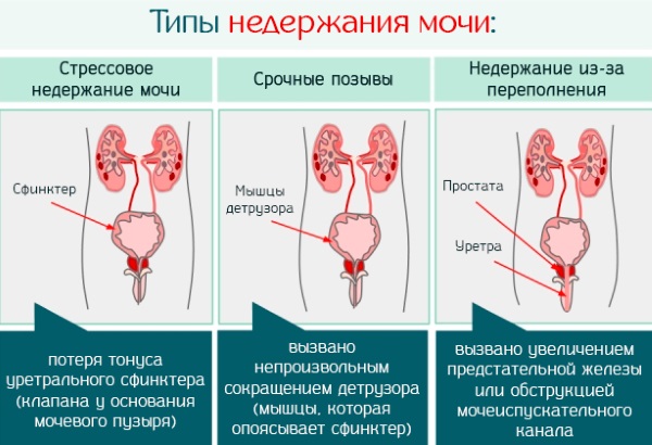 Энурез у взрослых женщин ночной. Причины и лечение