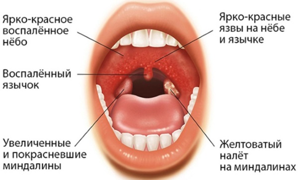 Фарингит у детей. Симптомы и лечение народными средствами, лекарственные препараты. Рекомендации врачей