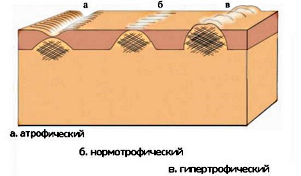 Ферменкол гель. Инструкция по применению от рубцов, шрамов, растяжек. Состав, цена, аналоги