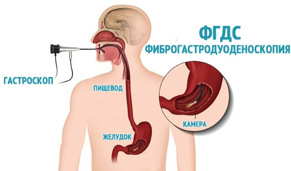 ФГДС. Отзывы о процедуре с обезболивающим, без наркоза, где лучше делать