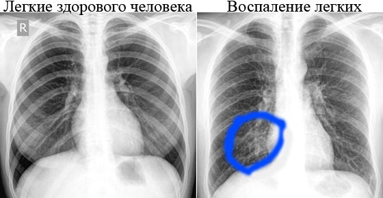 Флюорография. Что это, что показывает, результаты, как часто можно делать детям и взрослым, возможный вред