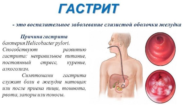 Гастрит. Симптомы и лечение у взрослых народными средствами, препараты, диета, рецепты. Классификация