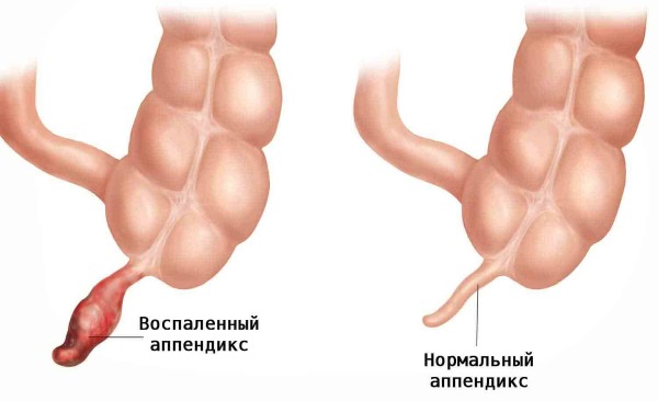 Газообразование в кишечнике. Причины и лечение: диета, препараты, народные средства