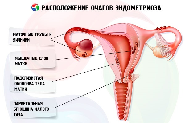 Гистероскопия матки (удаление полипа) в гинекологии. Подготовка, анализы, наркоз, как проводится, последствия