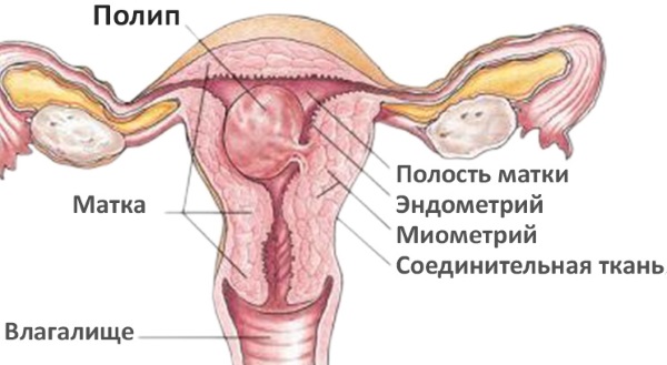 Гистероскопия матки (удаление полипа) в гинекологии. Подготовка, анализы, наркоз, как проводится, последствия