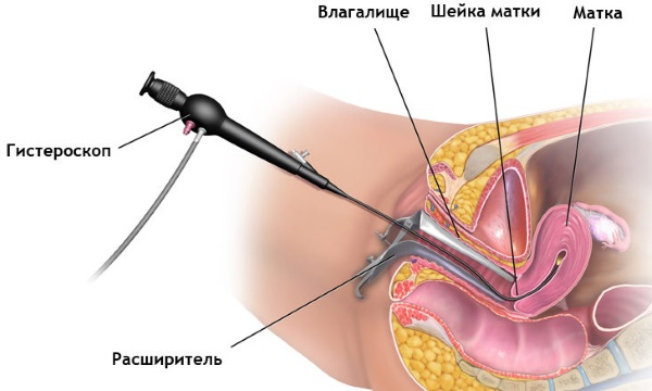 Гистероскопия матки (удаление полипа) в гинекологии. Подготовка, анализы, наркоз, как проводится, последствия