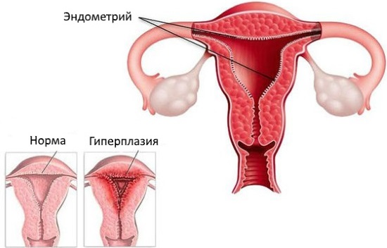 Гистероскопия матки (удаление полипа) в гинекологии. Подготовка, анализы, наркоз, как проводится, последствия