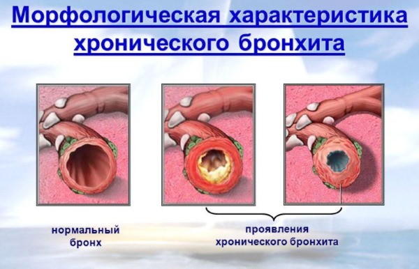 Карта вызова смп хронический бронхит обострение