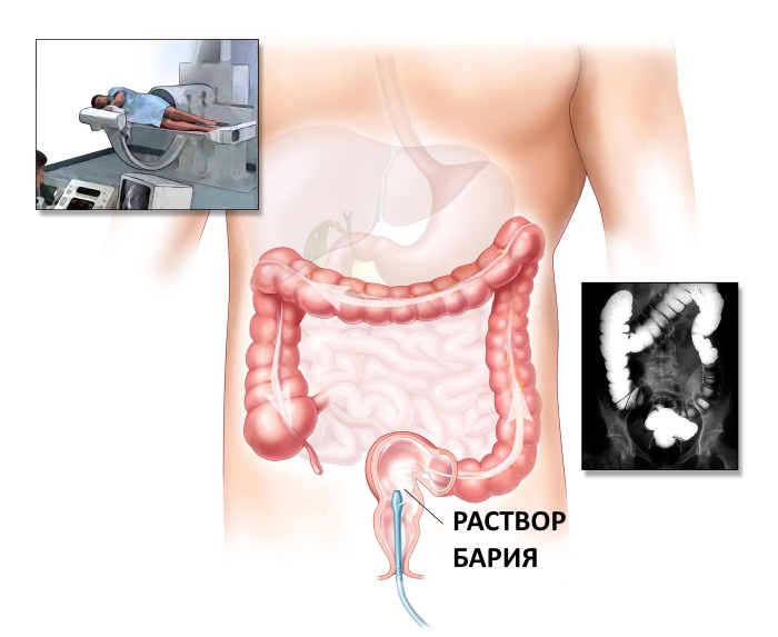 Ирригоскопия кишечника. Подготовка, как проводится, что показывает, чем лучше колоноскопии, МРТ. Где сделать