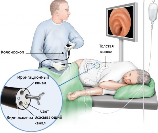 Ирригоскопия кишечника. Подготовка, как проводится, что показывает, чем лучше колоноскопии, МРТ. Где сделать