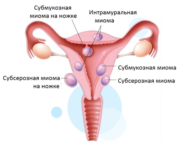 Как отличить месячные от кровотечения при климаксе, выкидыше, внематочной беременности, после родов, кесарева сечения, прижигания эрозии