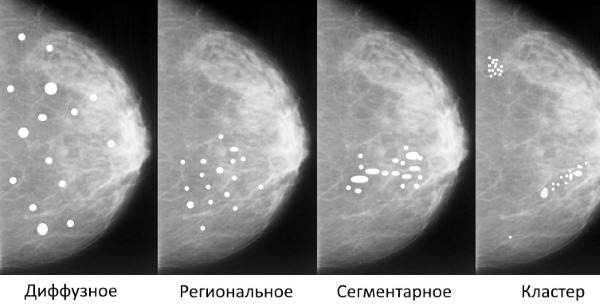 Кальцинаты в молочной железе. Что это такое: единичные, рассеянные микрокальцинаты, точечные на маммографии, УЗИ. Причины, лечение, диета