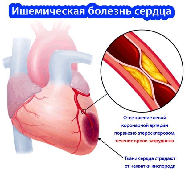 Кардиоаспирин. Инструкция по применению, показания, противопоказания, длительность лечения. От чего помогает, побочные эффекты. Цена, аналоги