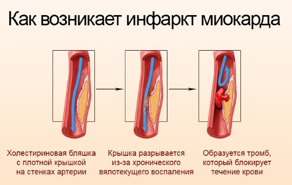 Кардиоаспирин. Инструкция по применению, показания, противопоказания, длительность лечения. От чего помогает, побочные эффекты. Цена, аналоги