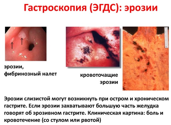 Кардиомагнил. Показания, инструкция по применению. Цена, отзывы, аналоги