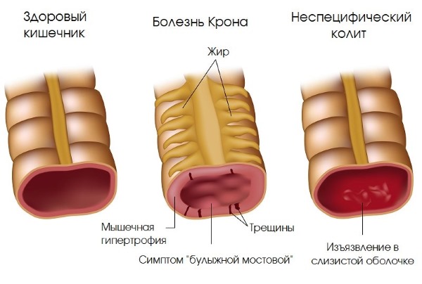 Колоноскопия кишечника. Что это, показания к обследованию, как делается, подготовка к процедуре