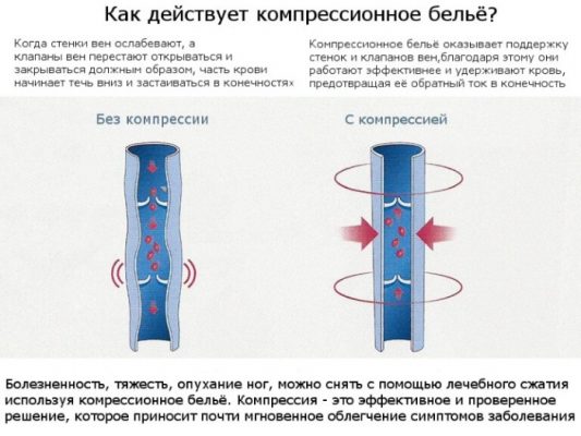 Схема одевания компрессионных чулок