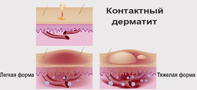 Контактный дерматит. Фото, симптомы и лечение, аллергический, простой. Мази, крема, лечение народными средствами