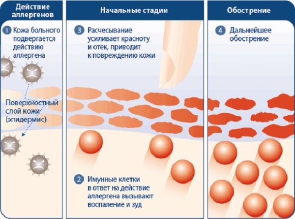 Контактный дерматит. Фото, симптомы и лечение, аллергический, простой. Мази, крема, лечение народными средствами