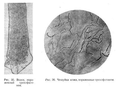 Лишай у ребенка. Фото признаков на теле, лице, голове, лечение народными средствами, медикаментозно