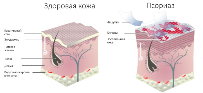 Лишай у ребенка. Фото признаков на теле, лице, голове, лечение народными средствами, медикаментозно