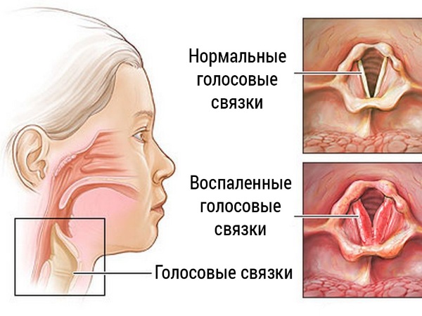 Лучшие средства от сухого кашля, недорогое, эффективное: сиропы, таблетки, народные средства