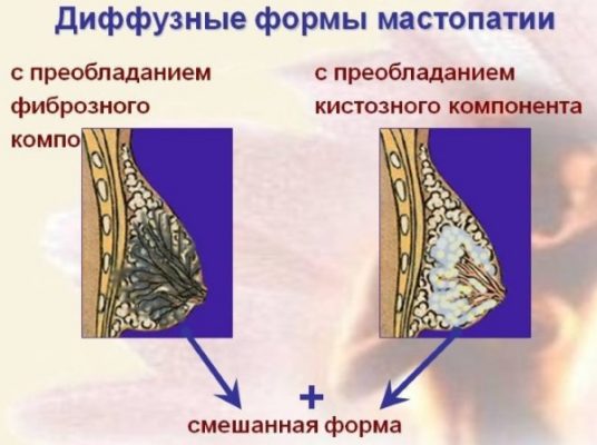 Рак молочной железы симптомы и признаки на ранних фото