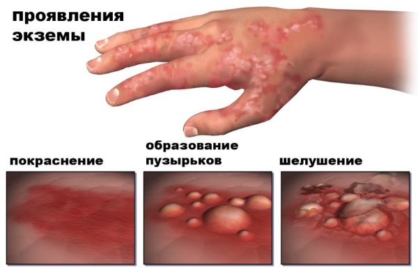 Мазь Элоком. Инструкция по применению, показания, для детей, при беременности. Цена, отзывы, аналоги