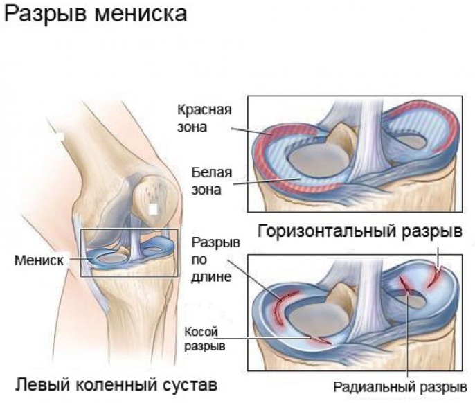 Мениска коленного сустава. Что это такое, симптомы разрыва, болезни, травмы, воспаления. Лечение, операция, последствия удаления