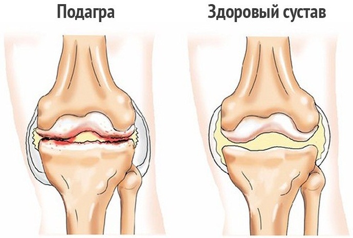 Мениска коленного сустава. Что это такое, симптомы разрыва, болезни, травмы, воспаления. Лечение, операция, последствия удаления