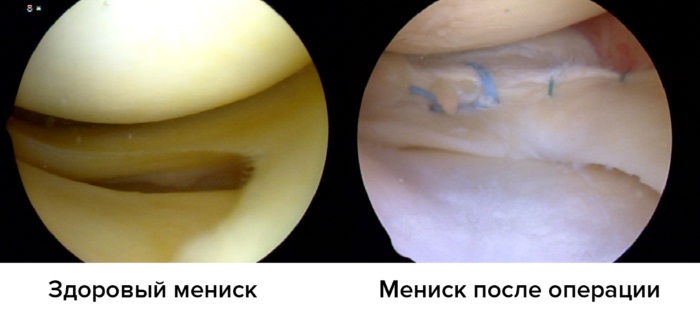 Мениска коленного сустава. Что это такое, симптомы разрыва, болезни, травмы, воспаления. Лечение, операция, последствия удаления