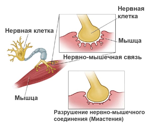 Миастения. Симптомы, причины возникновения, диагностика, лечение, диета, препараты