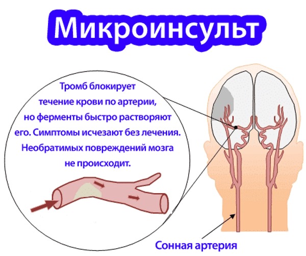 Люди после микроинсульта фото