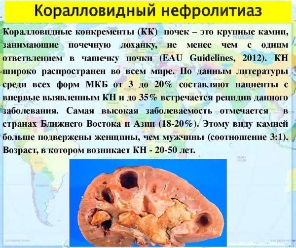 Мочекаменная болезнь. Симптомы и лечение у женщин травами, лекарства, диета. Как снять приступ в домашних условиях