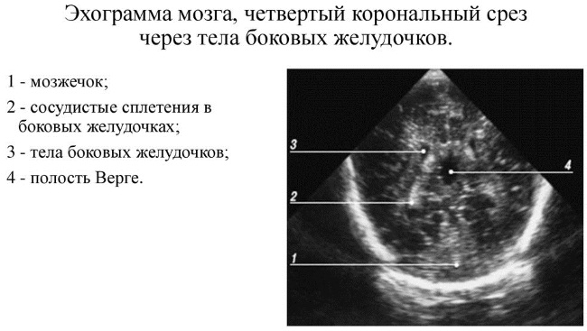 Нейросонография головного мозга у новорожденных. Нормы, таблица, когда делается, расшифровка результатов