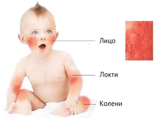 Норма нейтрофилов у детей по возрасту: сегментоядерные, палочкоядерные. Причины повышения, понижения, что делать