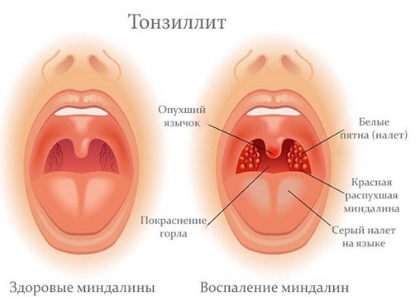 Норма нейтрофилов у детей по возрасту: сегментоядерные, палочкоядерные. Причины повышения, понижения, что делать